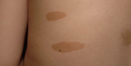 신경섬유종증의 담갈색 반점