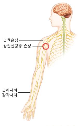 상완 근력 및 감각저하