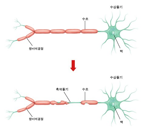 신경세포를 둘러싸고 있는 수초가 탈락된 CIDP 상태