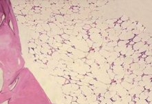 재생불량성빈혈 골수