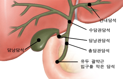 담석의 발생 위치에 따른 구분