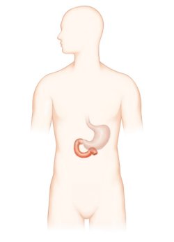 위장의 유문부(위의 끝부분, 위와 십이지장이 연결된 부위), 십이지장, 십이지장 구부(위장과 가까운 십이지장 입구)