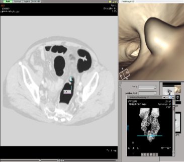 CT 대장조영술에서 발견된 대장암