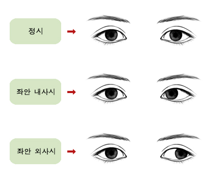 정상, 내사시, 외사시