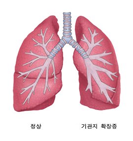 기관지확장증의 폐
