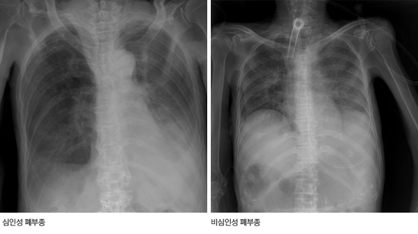 폐부종 X선 영상