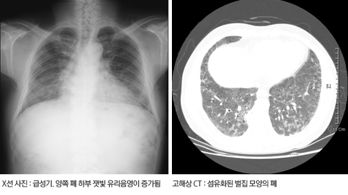과민성 폐장염 방사선 검사