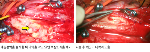 내막 제거술