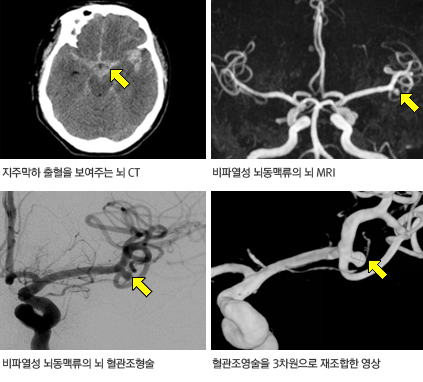 뇌동맥류 영상 검사