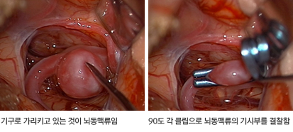 개두술을 하여 뇌동맥류를 직접 결찰하는 수술