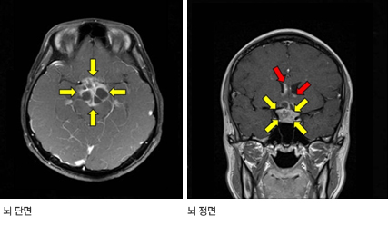 하수체에 발생한 배아세포종 MRI: 뇌척수액을 통해 뇌실(붉은 화살표)까지 전이