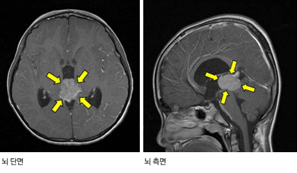 송과체에 발생한 배아세포종 MRI: 대뇌 수도관 압박으로 수두증이 동반됨