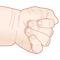 에드워드 증후군에 나타나는 손의 특징적인 모양