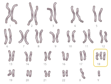 염색체 검사 사진: 18번 염색체가 3개 있음
