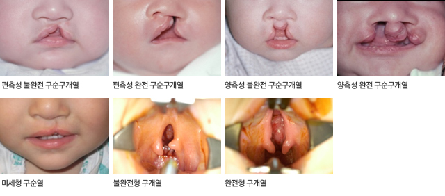 구순구개열 증상
