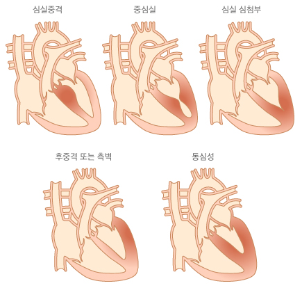 비후성 심근증의 형태학적 분류