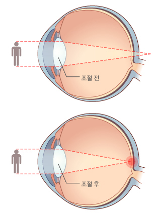 원시 증상