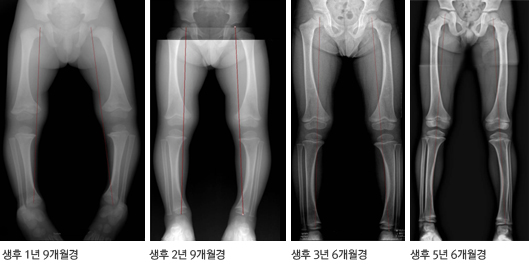 생리적 내반슬의 연령에 따른 변화