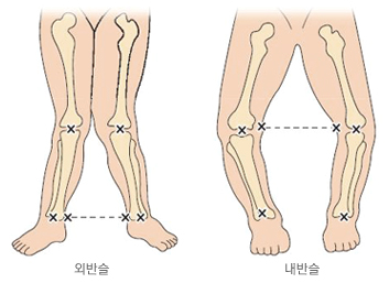 외반슬과 내반슬