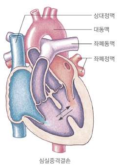 심실중격 결손