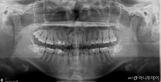 전신마취 후 매복치(사랑니)를 발치한 환자의 수술전 파노라마영상 /사진제공=연세대학교 치과대학병원