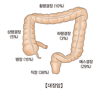 황행결장(10%) 하행결장(3%) 에스결장(29%) 직장(38%) 맹장(15%) 상행결장(5%)등 대장암이 발생하는 부위의 예시