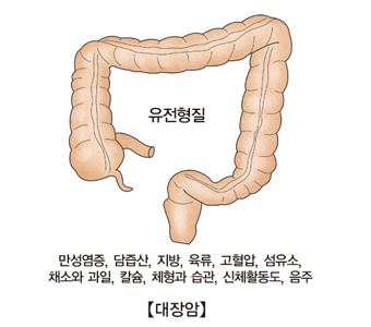 유전형질 만성염증 담즙산 지방 육류 고혈압 섬유소 채소와과일 칼슘 체형과습관 신체활동도 음주 등 대장암의 발생 요인 예시 