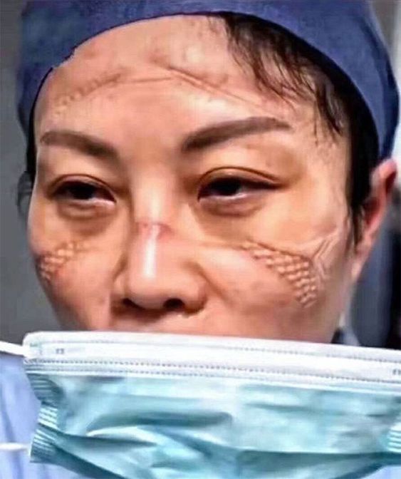 Chinese Nurses Share Pictures Of How Their Faces Look After Countless Hours Fighting The Coronavirus | Bored Panda