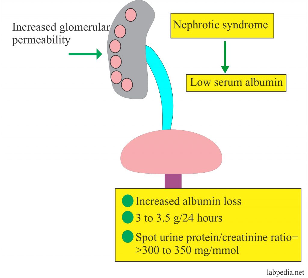 albumin and nephrotic syndrome albumin and nephrotic syndrome