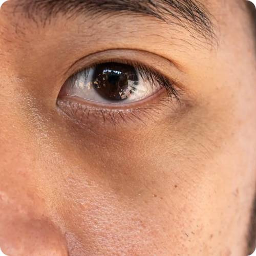 다크서클 없애는 법 5가지 유형별 솔루션! 얇은 눈가 피부 관리 비법 - 헬스뷰티