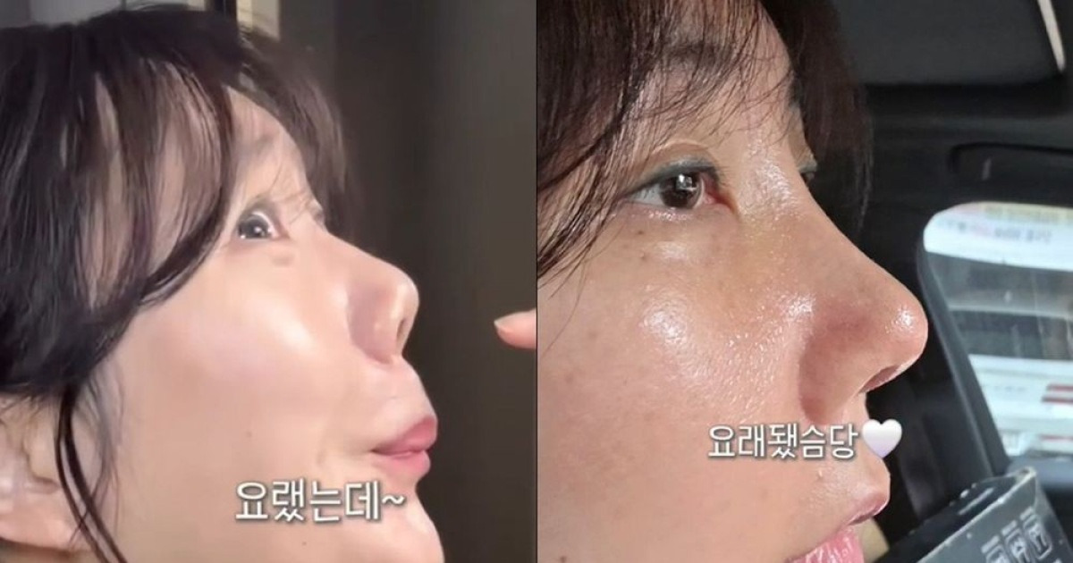 허안나, 코 구축→재수술 결과 공개…완전히 달라진 코 [RE:스타]
