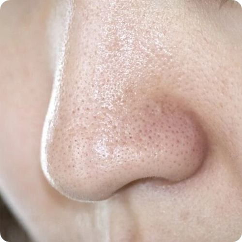 화이트헤드 없애는 법 4단계 완전 정복! 압출 없이 피지 녹이는법 - 헬스뷰티