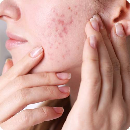 여드름 원인 5가지 핵심! 성인 여드름 부위별 발생 이유 - 헬스뷰티