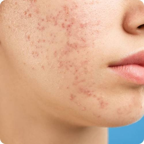 여드름 흉터 관리법 5단계 완벽 가이드! 흉터 유형별 맞춤 치료법 - 헬스뷰티