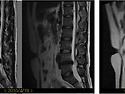 서 OO 회원님 MRI before & after 사진
