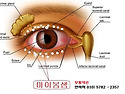 마이봄샘(눈꺼풀 안쪽 피지선)