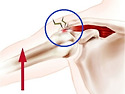 어깨통증, 팔을 들어 올릴때 아프다면 어깨충돌증후군 의심!!
