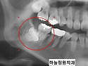 사랑니 진단 - patterns of impaction!