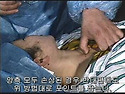 05. 흉쇄유돌근 손상(St..