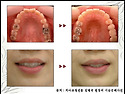 급속교정 - 강남역치과 치아교정전문의의 급속교정 시술증례