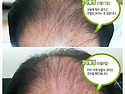 발모팩 60일 사용 후기,그 변화는?