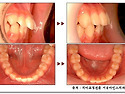 ■ 임플란트나 보철치료를 위한 앞니 치아교정 증례사진 및 시술소견