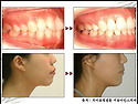 [치아교정 전문 김병국원장] - 돌출입교정 치아교정치료 증례 전후사진 및 시술소견