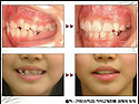 치아교정 - 초등학생의 치아교정 시술증례