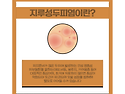 광주지루성두피염 원인은? 지루성 두피..