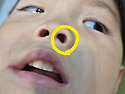 둘째가 코에 옥수수를 넣어..