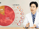 "뇌졸중, 갑작스러운 병 아냐… 절반 ..