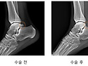 아들을 괴롭히던 뼛조각 ..