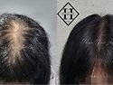 일산두피문신 여성 정수리..