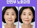 중년얼굴꺼짐, 지방이식으로 볼륨 자연스럽게 회복하기~